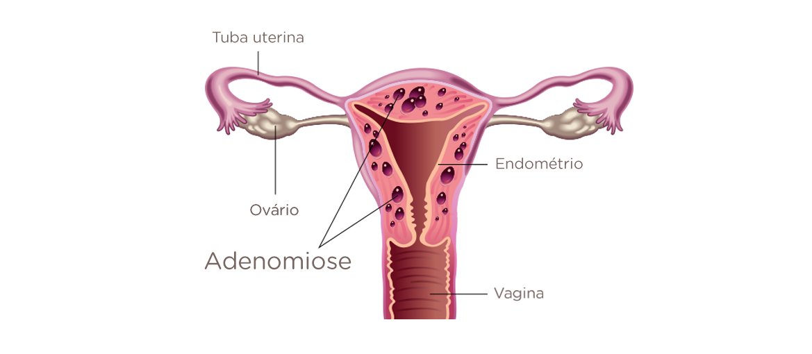 Adenomiose conheça os sintomas Dr Gustavo André